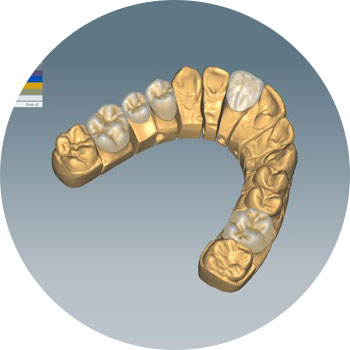 Abbildung einer Computersimulation eines Zahnmodelles