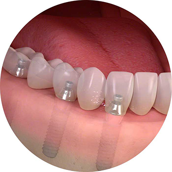 Darstellung Zahnersatz mit Implantat